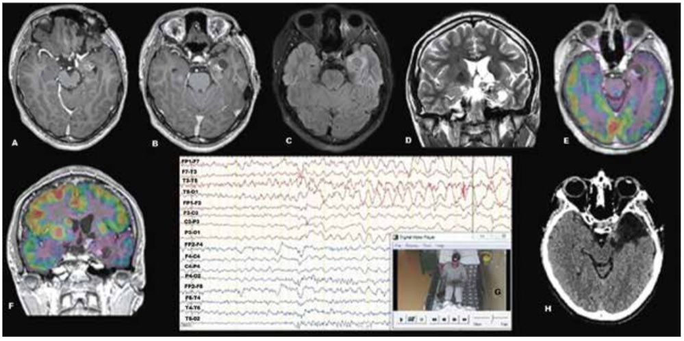 Estudio prequirúrgico para cirugía de epilepsia. RM de encéfalo: tumor quístico temporal anteromesial izquierdo y malacia orbitofrontal izquierda (A,B,C,D). PET scan interictal: extenso hipometabolismo izquierdo a predominio mesial (E,F). VideoEEG ictal: zona epileptógena temporal anterior – media izquierda (G). Tomografía cerebral postoperatoria: lobectomía temporal izquierda.