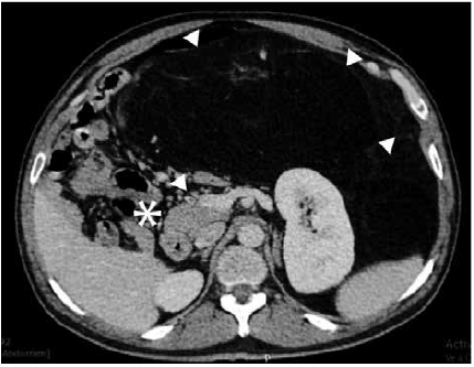 Extensa tumoración de bordes parcialmente definidos triángulos densidad de tejido graso y reticulaciones hiperdensas que ocupa gran parte de la cavidad abdominal con un diámetro transverso de 228 mm y desplaza asas intestinales y órganos adyacentes asterisco