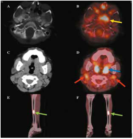 18FFDGPETCT Results Axial CT A and axial fused B images showing focal hypermetabolic intake in the sphenoid lesion yellow arrow Axial CT C and axial fused D images showing focal hypermetabolic intake in the bilateral nasal cavity blue arrow and bilateral laterocervical nodes red arrow Sagittal CT fused E and coronal CT fused F images showing focal hypermetabolic intake in the medial diaphysis of the left tibia green arrows