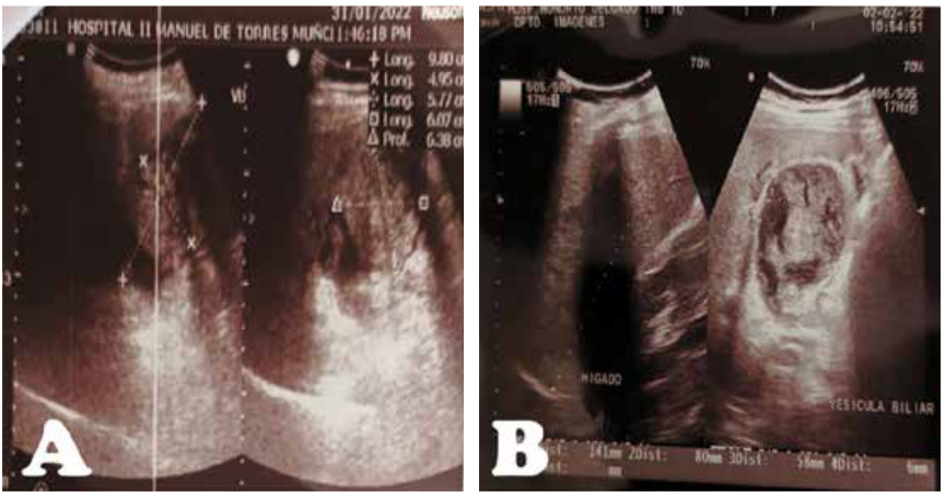 A, Ecografía abdominal del hospital de Mollendo: Vesícula de 9.8x4.9cm de paredes delgadas con contenido líquido, con presencia de “formación tumoral de 5x6cm de ecoestructura heterogénea con dos imágenes hiperecogénicas en su interior”. B, Ecografía abdominal en nuestra institución: Vesícula biliar distendida de 80x58mm, de paredes engrosadas de 6mm, con imágenes isodensas en su interior, al parecer no dependientes de pared, si flujo doppler, sugerente de contenido biliar denso, con imagen litiásica en su interior de 14mm.