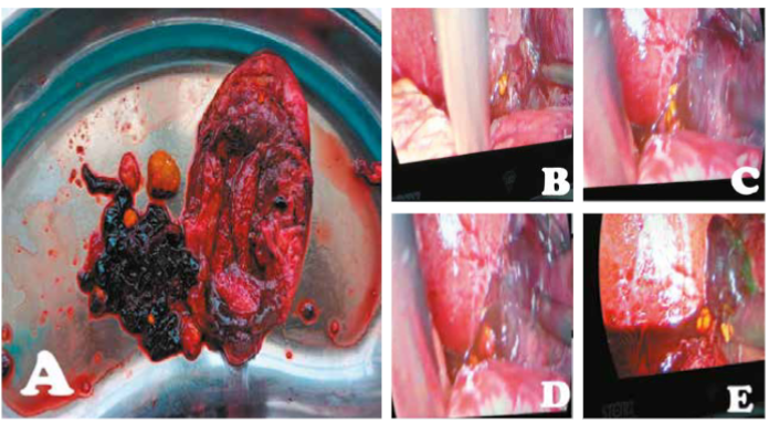  Hallazgos intra-operatorios. A, Vesícula distendida de 15x8x6cm gangrenada en cuerpo y bacinete, conteniendo en su interior coágulos organizados color rojo oscuro, y múltiples cálculos, el mayor de 15mm. B,C,D y E, Salida de contenido vesicular (coágulos y cálculos) durante la colecistectomía laparoscópica