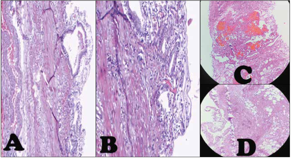 Estudio histopatológico. Pared de vesícula biliar con mucosa erosionada y con exudado inflamatorio tipo linfocitario y neutrofílico. A y D, Aumento 100X, B Aumento 200X, C, Zonas de hemorragia y necrosis.