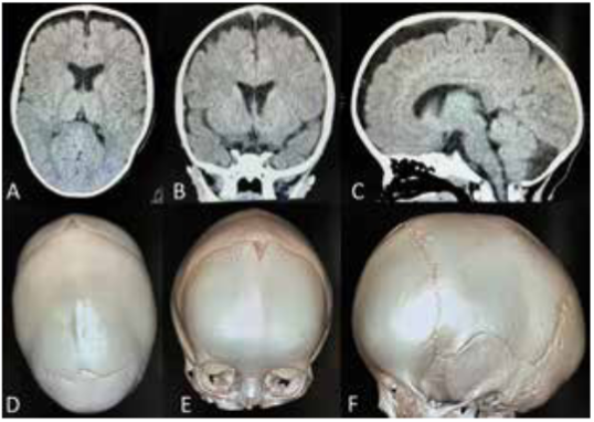 Tomografía cerebral sin contraste y Reconstrucción 3D. A. corte axial cerebral, B. corte coronal cerebral, C. corte sagital cerebral, D. vista superior craneal, E. vista frontal craneal, F. Vista lateral craneal.