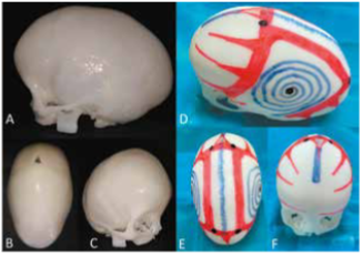 Impresión 3d a escala real. A. vista lateral sin preparación, B. Vista superior sin preparación, C. Vista frontal- lateral sin preparación, D. Planificación quirúrgica de cara lateral izquierda, E. planificación quirúrgica de cara superior, F. planificación quirúrgica de cara frontal.