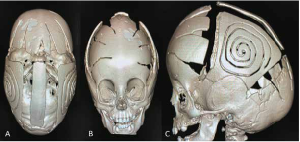 Reconstrucción 3d post operatoria. A. vista superior, B. vista frontal, C. vista sagital.