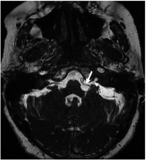 RMN cerebral en secuencia FIESTA donde se logra ver la arteria PICA izquierda (flecha gruesa) que llega a contactar al IX PC izquierdo (flecha delgada) que se dirige hacia el foramen yugular.