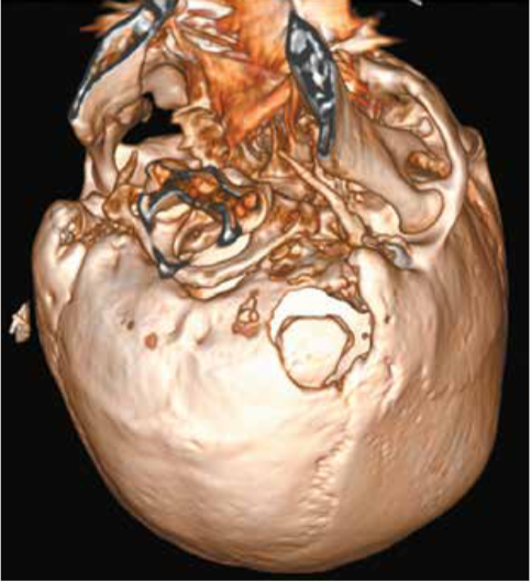 TAC cerebral sin contraste en reconstrucción 3D de ventana ósea donde se observa la craneotomía suboccipital lateral retromastoidea izquierda.