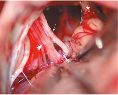 Vista intraoperatoria con un abordaje cerebeloso infralateral donde se logra visualizar en la derecha el complejo VII-VIII PC (estrella), el IX PC izquierdo (flecha pequeña), las raíces del X PC izquierdo (cabeza de flecha) y el XI PC hacia la izquierda (cruz). Se puede ver que la PICA izquierda (flecha gruesa) comprime el IX y X PC izquierdo.