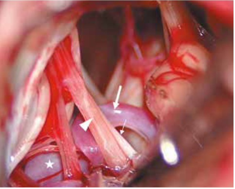 Vista intraoperatoria donde se ha logrado separar el loop proximal de la PICA izquierda (flecha gruesa), lo que ha sido influenciado por una dolicobasilar que genera que la arteria vertebral izquierda este más lateral de lo habitual (estrella). Se logra evidenciar el IX PC izquierdo aún comprimido (flecha delgada) y las raíces superiores del X PC izquierdo (cabeza de flecha) aún comprimidas.