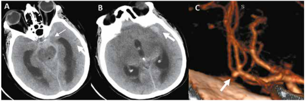 A Y B. TAC cerebral sin contraste en corte axial. A. Se evidencia a nivel de las cisternas basales a predominio de lado izquierdo una hemorragia subaracnoidea (flecha pequeña), además de dilatación de las astas temporales (flecha grande). B. Se evidencia hemorragia subaracnoidea gruesa a nivel del valle de Silvio izquierdo (flecha). C. Reconstrucción 3D de la angiotomografía cerebral donde se evidencia un aneurisma blister de la arteria cerebral media derecha no roto (flecha).