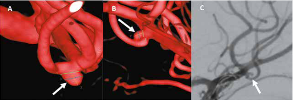 A. Angiografía con reconstrucción 3D de la arteria carótida interna derecha en donde se evidencia un aneurisma blíster de la trifurcación de la arteria cerebral media derecha no roto, de 2.5x1.92mm con cuello de 2.38mm (flecha). B. Angiografía con reconstrucción 3D de la arteria carótida interna izquierda en donde se evidencia un aneurisma blíster de la trifurcación de la arteria cerebral media izquierda roto, de 1.27x1.24mm con cuello de 1.22mm (flecha). C. Angiografía de la arteria carótida interna izquierda en incidencia oblicua donde se logra evidenciar el aneurisma de la trifurcación de la arteria cerebral media izquierda roto (flecha).