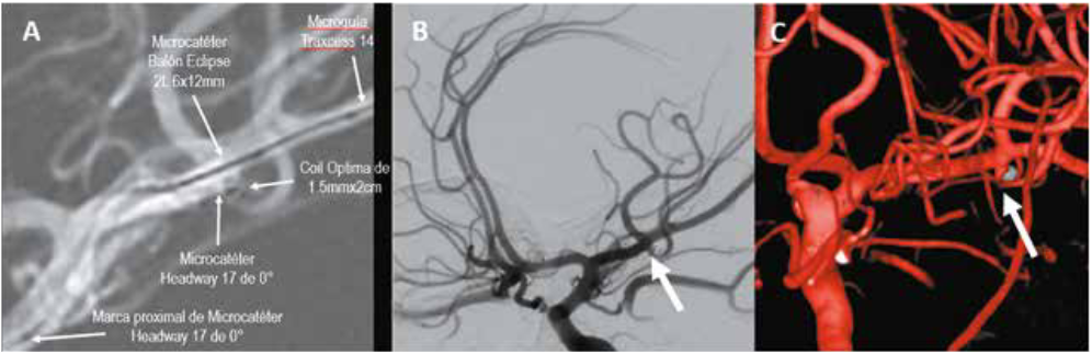A. Road mapping de la arteria carótida interna izquierda donde se logra visualizar el microcatéter balón que se usó con su respectiva microguía, además del primer coil con el que se intentó embolizar, pero que migraba hacia la rama temporal de la arteria cerebral media, así como el microcatéter que se usaba para el coiling. B. Angiografía en incidencia oblicua con ángulo negativo de la arteria carótida interna izquierda que evidencia aneurisma blíster embolizado con coils (flecha) y patencia de todas las estructuras vasculares. C. Angiografía con reconstrucción 3D de la arteria carótida interna izquierda donde se evidencia aneurisma blíster embolizado con coils (flecha) y patencia de todas las estructuras vasculares.