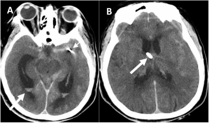 TAC cerebral sin contraste en corte axial. A. Se evidencia aumento de la irrupción ventricular con hidrocefalia en iguales magnitudes (flecha grande) y material de embolización en territorio de arteria cerebral media izquierda (flecha pequeña). B. Se evidencia catéter ventricular frontal derecho en agujero de Monro (flecha), con disminución del tamaño ventricular.