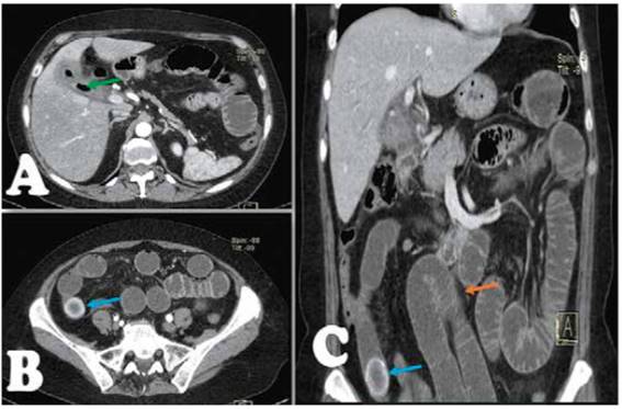  Tomografía abdominal trifásica. Tríada de Rigler. A, Flecha verde, aerobilia. B (Corte transversal) y C (Corte Coronal), cálculo en íleon distal (Flecha azul), y adyacente al mismo, distención de asas intestinales (Flecha naranja).