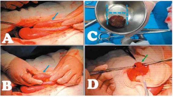  Hallazgos intra-operatorios. A y B Identificación del cálculo en íleon distal (Flecha azul). C, Extracción del cálculo mediante enterotomía. D, Cierre de enterotomía de forma transversal (Flecha verde).