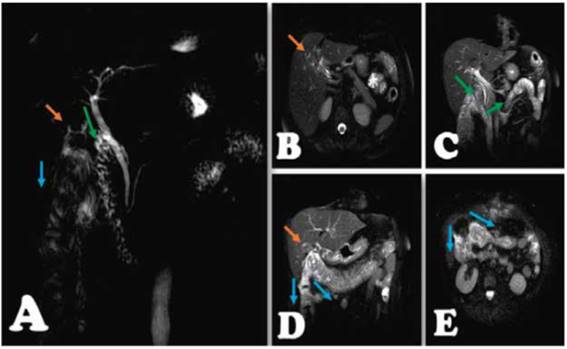  Colangioresonancia. A, Reconstrucción de vía biliar, Localización de la vesícula (Flecha naranja), probable conexión de la misma con duodeno y pasaje de contraste al mismo (Flecha verde), y probable conexión de la misma con colon (Flecha azul). B Aerobilia (Flecha naranja). C Pasaje de contraste a duodeno y asa delgada (Flecha verde). D y E, Vesícula biliar (Flecha naranja) y paso de contraste a colon ascendente y transverso (Flecha azul).