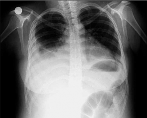 Segundo caso Se puede observar derrame pleural a predominio derecho con rectificación de los bordes cardiacos Se trataba de una serositis pleuropericárdica