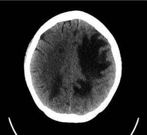 Primer caso Tomografía cerebral al ingreso por emergencia Se observa área hipodensa que compromete áreas frontal y parietal izquierdos