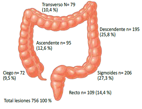 Mucosectomía CRP Distribución de las lesiones en el colon