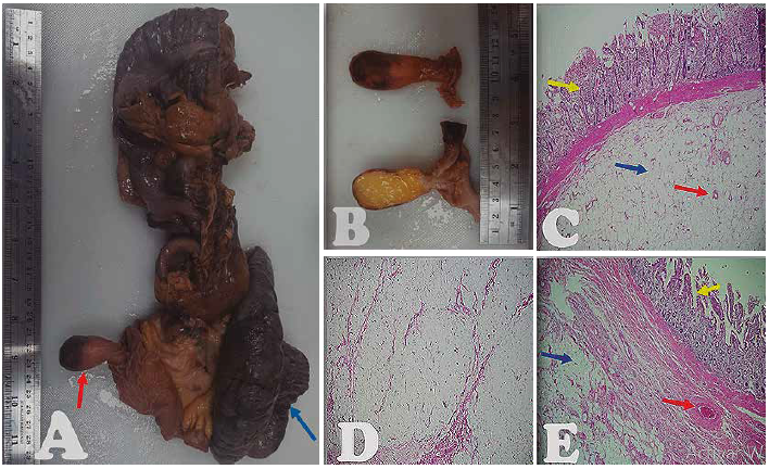 Estudio histopatológico A Pieza quirúrgica: Íleon terminal colon y ciego que en conjunto mide 24x7cm en la que se identifica intususcepción íleo colónica Cabeza de la invaginación con pólipo pedunculado fecha roja seguida por Íleon necrótico fecha azul B Lesión polipoide de 45x25x2cm y pedículo de 2x1cm que se encuentra a 7cm de borde quirúrgico ileal y a 24cm de borde quirúrgico de colon Al corte del pólipo se evidencia tejido de aspecto adiposo amarillento homogéneo C Microfotografía de pólipo pedunculado de íleon: Mucosa ileal con inflamación crónica y aguda flecha amarilla Tejido adiposo maduro bien delimitado de ubicación submucosa flecha azul con vasculatura prominente ramificada de paredes delgadas y del tamaño de capilares flecha roja 20X HE D Tejido adiposo maduro en espacio submucoso E Microfotografía de pólipo pedunculado de íleon: Mucosa ileal con inflamación crónica y aguda flecha amarilla Tejido adiposo maduro de ubicación submucosa flecha azul con vascularización más prominente en la periferia flecha roja No se evidencia atipia nuclear en el componente adipocítico ni vascular 20X HE Diagnóstico de Angiolipoma submucoso de Íleon