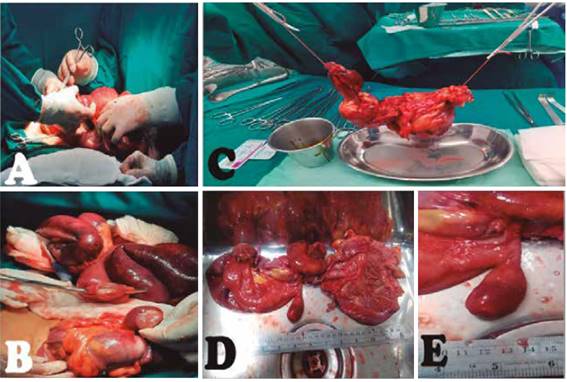 Intervención quirúrgica. A, Identificación de la intususcepción B Resección de segmentos comprometidos íleon ciego y colon ascendente y preparación de ileostomía a 20cm de la válvula ileocecal C Obtención y marcado de pieza operatoria íleo terminal ciego y colon ascendente D Pieza operatoria con lesión ileal polipoide E Lesión polipoide que sale de mucosa ileal