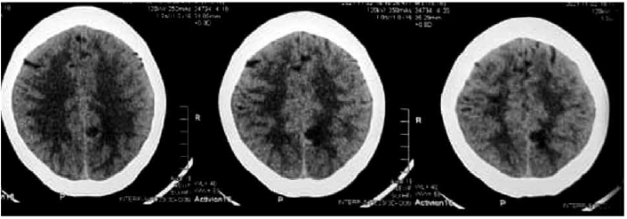 Tomografía cerebral control se evidencia hipodensidad en región parietal izquierda sin evidencia de sangrado agudo ni edema perilesional.