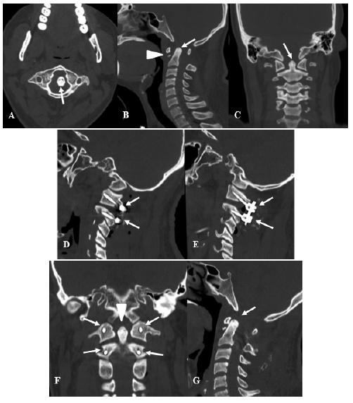 Varón de 25 años que sufre caída libre desde un segundo piso ingresando con cuadriparesia moderada 35 diagnosticando invaginación basilar por lo cual se le realiza una fijación interarticular C1C2 con mejoría del déficit motor en el posoperatorio inmediato 45 A B y C TEM de columna cervical preoperatoria A Corte axial donde se evidencia que la apófisis odontoides se encuentra desplazada hacia atrás y la izquierda flecha B Corte sagital donde se evidencia desplazamiento de la apófisis odontoides hacia superior y posterior flecha además de fractura del borde inferior del arco anterior de C1 cabeza de flecha C Corte coronal donde se evidencia apófisis odontoides desplazada hacia la izquierda flecha D E F y G TEM de columna cervical posoperatoria de una artrodesis interarticular D Corte sagital donde se logran evidenciar los tornillos de C1 y C2 flechas en el lado derecho E Corte sagital donde se evidencian los tornillos de C1 y C2 flechas en el lado izquierdo F Corte coronal donde se evidencia odontoides ya en ubicación central cabeza de flecha además de los 4 tornillos de la fijación interarticular flechas con correcta situación del sistema G Corte sagital donde se evidencia adecuada reducción de la apófisis odontoides desplazada flecha