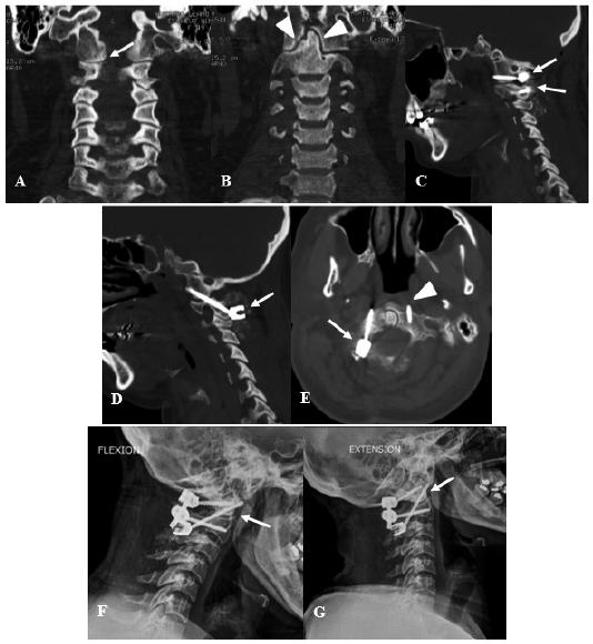 Mujer de 49 años con antecedente quirúrgico de descompresión occipitocervical por malformación de Chiari quien presentó cervicalgia severa EVA 1010 debido a inestabilidad atlantoaxoidea por lo que se procede a una artrodesis C1C2 con posterior mejoría clínica significativa A y B Tomografía espiral multicorte TEM de columna cervical preoperatoria en corte coronal donde se logra evidenciar la presencia de aire en articulación C1C2 derecha flecha además de bordes escleróticos en la articulación de la odontoides con C1 cabeza de flecha los cuales son signos radiológicos de inestabilidad segmentaria C D y E TEM de columna cervical posoperatoria C Corte sagital donde se logra evidenciar una artrodesis interarticular C1C2 flechas del lado derecho luego de un primer intento de fijación transarticular frustro D Corte sagital donde se evidencia el tornillo transarticular C1C2 del lado izquierdo flecha E Corte axial donde se logra evidenciar C1 con el tornillo en el lado derecho flecha y el extremo distal del tornillo transarticular C1C2 del lado izquierdo cabeza de flecha F y G Radiografía funcional de la columna cervical en flexión F y en extensión G donde no se evidencia movilidad interarticular C1C2 flecha lo cual indica que se ha logrado la estabilidad segmentaria