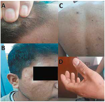 Lesiones dérmicas umbilicadas en A) Cuero cabelludo B) Región temporal C) Región posterior del tórax D) Dorso de la mano izquierda.