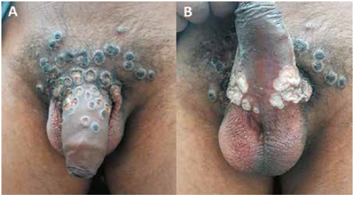 Lesiones dérmicas umbilicadas en A) Dorso del pene B) Región ventral del pene.