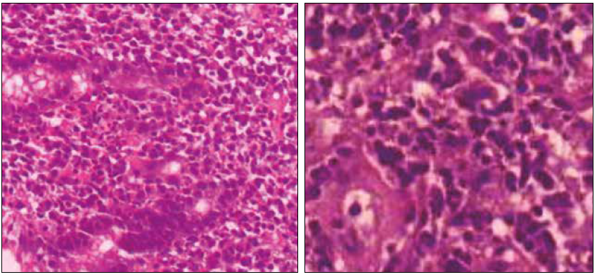 Imágenes de Anatomía Patológica mostrando mucosa gástrica infiltrada con linfocitos pleomórficos de pequeño o gran tamaño izquierda que contienen núcleos multilobulados derecha