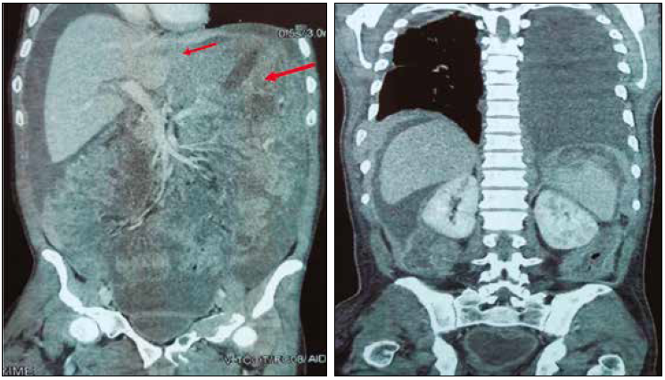 Tomografia de abdomen superior inferior y tórax mostrando abundante líquido en cavidad pélvica de aspecto heterogéneo Múltiples lesiones de aspecto lítico en hueso ilíaco izquierdo acetábulo y pubis algunos con crecimiento exofítico y extensión a partes blandas Hallazgo sugestivo de trombosis profunda en territorio de femoral común derecha Masa sólida hipocaptadora de aspecto neoproliferativo en la curvatura menor del fondo gástrico con crecimiento hacia el epiplón menor ver flechas rojas Metástasis retroperitoneal