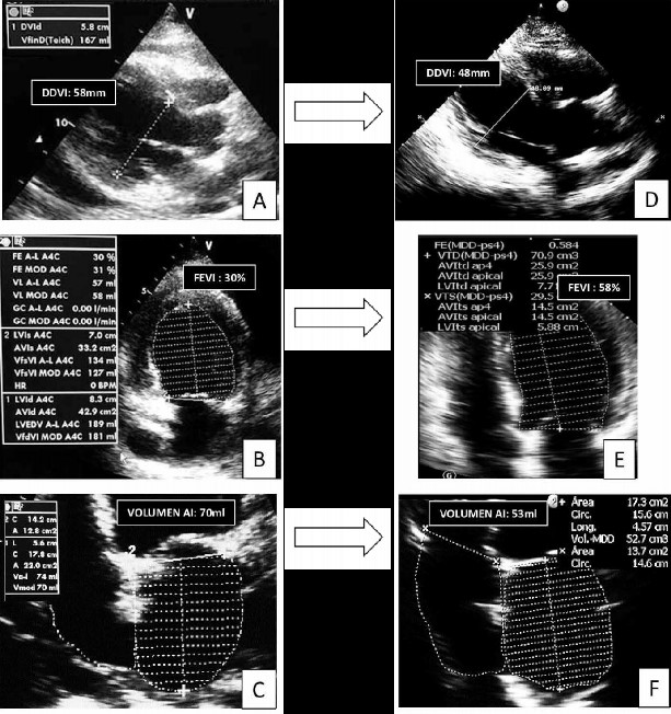 Ecocardiografía Transtorácica A B C Se muestra diámetro diastólico del ventrículo izquierdo DDVI fracción de eyección del ventrículo izquierdo FEVI y volumen de la aurícula izquierda AI respectivamente además en A se observa la presencia del derrame pericárdico E F G Se muestra DDVI FEVI y volumen de la AI siete meses después de tratamiento con levotiroxina respectivamente