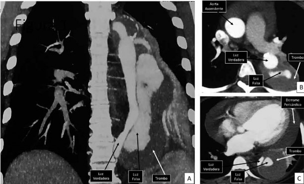 Tomografía torácica con contraste. A: Corte coronal, se evidencia la disección de la aorta tipo Stanford B. B: Corte axial, muestra la disección de la aorta torácica descendente con la luz verdadera y la luz falsa con trombosis. C: Corte axial, muestra la disección de la aorta con la luz verdadera y la luz falsa con trombosis, dilatación del ventrículo izquierdo y derrame pericárdico.