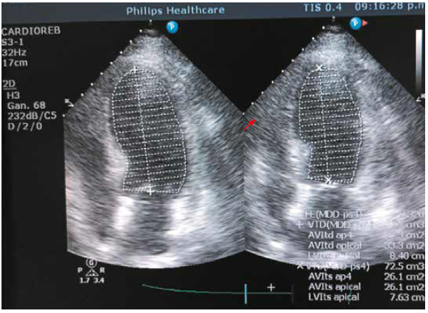 Transesophageal echocardiography not showing vegetations