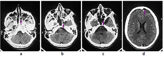 a,b,c. Tomografía helicoidal multicorte (TEM) ventana cerebral se evidencia fractura a de región etmoidal izquierda (). d. Se evidencia imagen isodensa con halo hiperdenso asociado a neumoencefalo () en región frontal izquierda.