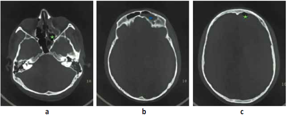 a. Tomografía helicoidal múlticorte (TEM) ventana ósea se evidencia fractura a nivel de región etmoidal asociada a presencia de líquido. b. Se evidencia fractura a nivel de seno frontal izquierdo y presencia de hemorragia (). c. Se evidencia neumoencefalo en región frontal izquierda ().