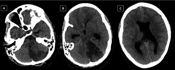 TEM de encéfalo sin contraste visión axial al ingreso hospitalario del paciente A área de isquemia cerebelosa izquierda que genera efecto de masa y colapso del cuarto ventrículo Edema del parénquima cerebeloso B área de isquemia cerebelosa izquierda Se visualiza dilatación del tercer ventrículo y astas temporales de los ventrículos laterales Ausencia de surcos y cisuras del encéfalo C dilatación de ventrículos laterales y cierto grado de líquido periventricular Ausencia de surcos y cisuras cerebrales