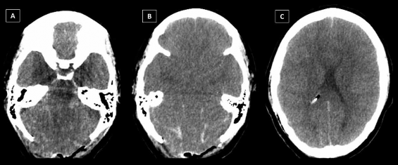 TEM de encéfalo sin contraste visión axial posterior a la realización de descompresión suboccipital en el paciente A áreas de isquemia cerebelosa bilateral edema cerebeloso bilateral colapso de las cisternas de la fosa craneal posterior y cuarto ventrículo y protrusión de parénquima cerebeloso por área de craniectomía suboccipital Hemorragia subaracnoidea en estructuras de la fosa craneal posterior B edema cerebral difuso bilateral ausencia de visibilidad de surcos de la convexidad frontotemporal cisternas silvianas y ventrículos Hemorragia subaracnoidea en la cara tentorial del cerebelo C edema cerebral difuso con ausencia de surcos de la convexidad colapso parcial de ventrículos laterales e identificación de la punta del catéter proximal de la DVE en el ventrículo lateral derecho Hemorragia subaracnoidea discreta en surcos de la convexidad