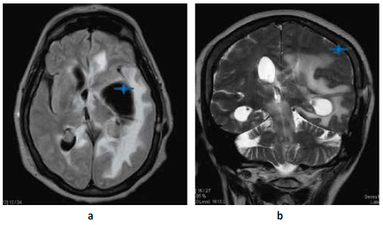 a. RMN cerebral T1 se evidencia colocación de sistema de derivación ventriculoperitoneal SDVP en ventrículo lateral Izq b. Corte coronal donde se evidencia cabo proximal de SDVP