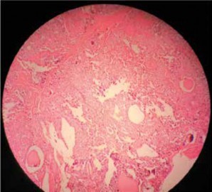 Histopatología de carcinoma papilar de tiroides.