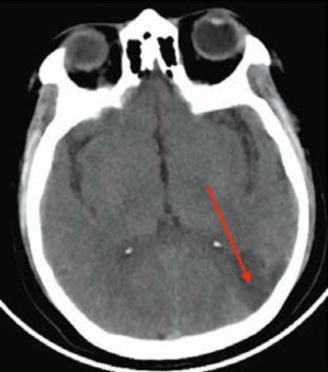 Tomografía cerebral sin contraste hipodensidad segmentaria en «cuña» flecha roja en región temporoccipital izquierda