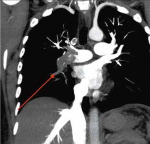 Angiotomografía pulmonar trombo obstructivo flecha roja de las 5 ramas de la arteria pulmonar derecha