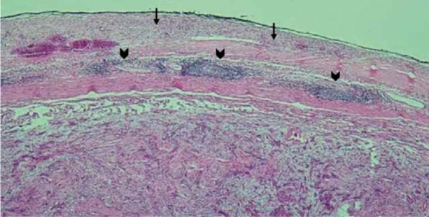 Muestra ciego tinción H&E Aumento 100 x. Se observa cúmulos linfoides peritumorales en forma de borde de tumor rodeado por tejido linfático cabeza de flechas además de infiltración aguda de células inflamatorias flechas