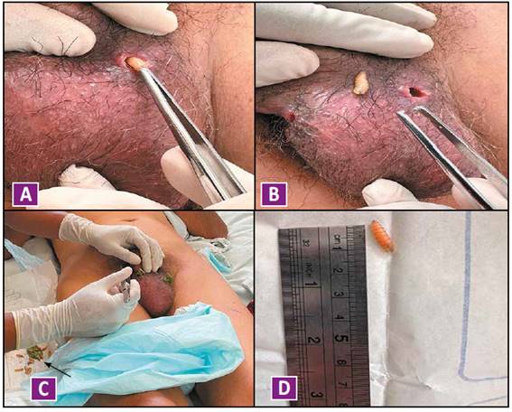 Extracción manual de múltiples larvas, de 1,5 cm de largo x 0,5 cm de ancho se observa anillos transversales en el cuerpo.