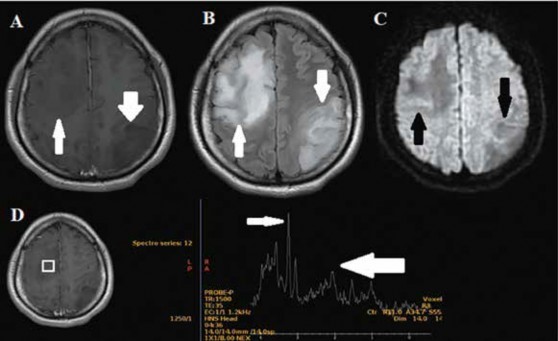 RMN cerebral contrastada preoperatoria. A. En imagen T1 contrastada se observa dos lesiones hipointensas difusas y mal definidas no captadoras de contraste en región frontal derecha (flecha) y parietooccipital izquierda (flecha gruesa), ambas con edema vasogénico perilesional. B. Dichas imágenes son suprimidas en la secuencia flair (flecha). C. En el estudio de difusión se evidencia restricción leve en algunos fragmentos (flecha). D. La curva de espectroscopia muestra elevación de la colina (flecha) y descenso del pico de n-acetilaspartato (flecha gruesa) en el boxel que está en la lesión frontal derecha.