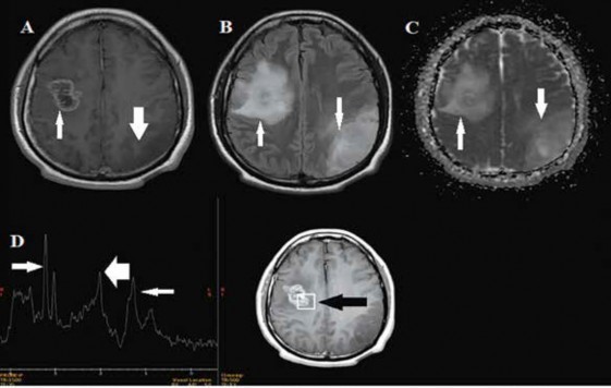 RMN cerebral contrastada control a los 8 meses posoperatorios. A. En imagen T1 contrastada se observa lesión parietooccipital izquierda con ligera disminución del volumen (flecha gruesa) y lesión frontal derecha con captación de contraste en la periferia e hipointensidad en el centro como secuela posquirúrgica (flecha). B. Supresión leve en secuencia FLAIR en ambas lesiones (flecha). C. Restricción en ambas lesiones en la secuencia de difusión (flecha). D. La curva de espectroscopia muestra elevación de la colina (flecha), descenso del pico de n-acetilaspartato (flecha gruesa) y un pico pequeño de lípido/lactato en el boxel que está en la lesión frontal derecha (flecha oscura).