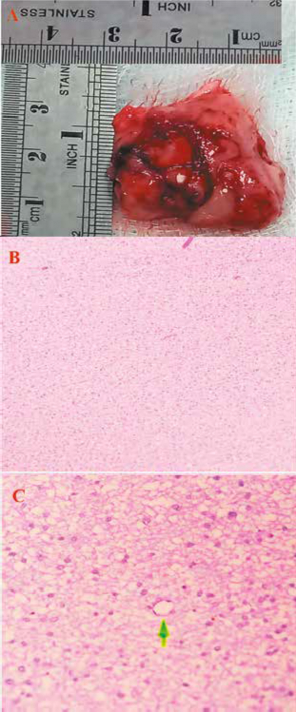 Pieza operatoria de 3x3 cm que se evidencia hiperémica. B. Tumor astrocítico con moderada hipercelularidad. HE 10x. C. Proliferación de células gliales con atipia leve, no se observa mitosis, necrosis ni hiperplasia vascular. HE 40x.