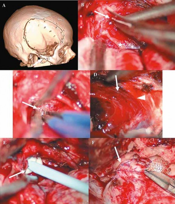 Reconstrucción tomográfica ósea 3D que evidencia la craneotomía fronto temporal derecha, además se puede evidenciar que se resecó el zigoma (flecha) para proceder al abordaje del tumor. B, C, D, E, F. Imágenes intraoperatorias. B. Se incide la cápsula del tumor del seno cavernoso con microtijera (flecha) y se logra observar el IV nervio craneal derecho (asterisco). C. Se evidencia la cavidad intatumoral luego del debulking (fecha), lo cual está siendo coagulado con bipolar. D. Se logra ver el tumor hacia anterior (flecha) y el límite posterior de la tumoración (cabeza de flecha). E. Se coloca Surgiflo ® (flecha) en el lecho quirúrgico para cohibir el sangrado profuso, lo cual se logra de manera adecuada. F. Se cierra de manera hermética las paredes del seno cavernoso derecho (flecha).