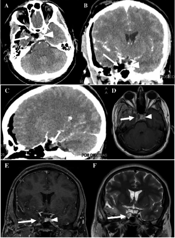 Tomografía cerebral contrastada posoperatoria inmediata. A. Corte axial donde se evidencia resección total de la tumoración (flecha) y la hipófisis desplazada hacia la izquierda (cabeza de flecha). B. Corte coronal donde no se logra evidenciar la tumoración (flecha) con la hipófisis desplazada hacia la izquierda (cabeza de flecha). C. Corte sagital donde no se evidencia la tumoración (flecha). D, E y F. Resonancia cerebral posoperatoria 2do mes. D. Corte axial, secuencia T1 con contraste, donde se evidencia secuela posquirúrgica, pero con resección total de la lesión (flecha), con hipófisis desplazada hacia la izquierda (cabeza de flecha). E. Corte coronal, secuencia T1 con contraste, donde se logra evidenciar lecho quirúrgico sin presencia de tumor (flecha), con hipófisis desplazada hacia la izquierda (cabeza de flecha). F. Corte coronal, secuencia T2, donde se evidencia lecho quirúrgico sin presencia de tumor (flecha).